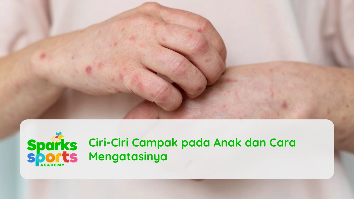 Ciri-Ciri Campak pada Anak dan Cara Mengatasinya